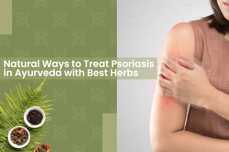 Natural Ways to Treat Psoriasis in Ayurveda with Best Herbs