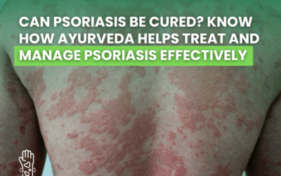 Can Psoriasis Be Cured? Know How Ayurveda Helps Treat and Manage Psoriasis Effectively