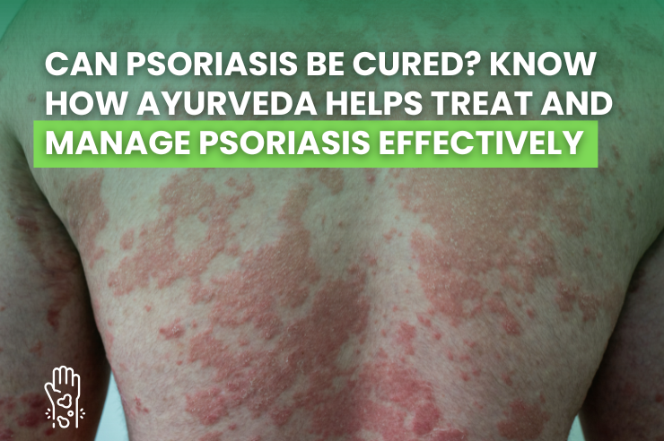 Can Psoriasis Be Cured? Know How Ayurveda Helps Treat and Manage Psoriasis Effectively